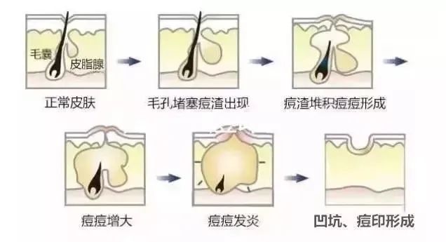 痘坑的形成 如何祛除痘坑?祛除痘坑最好的方法