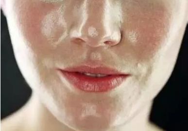 油性皮膚 不同膚質(zhì)應該如何正確護膚?