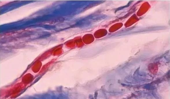 紅血絲 紅血絲形成的原因!