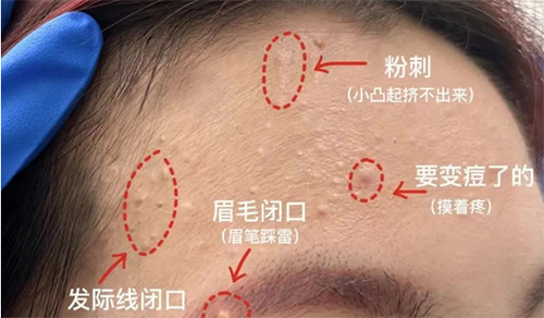 臉上經常長閉口粉刺的原因有哪些？