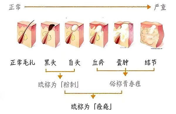 認識黑頭 黑頭怎么去除最有效?去除黑頭最有效的方法