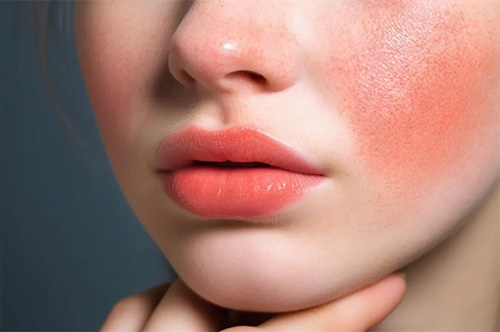 皮膚過敏 秋季皮膚為什么容易過敏?