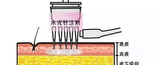 水光針 水光針的類型有哪幾種?