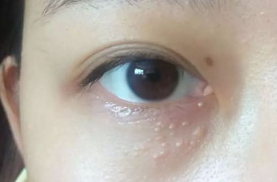 眼部脂肪粒 為什么眼部容易長脂肪粒?
