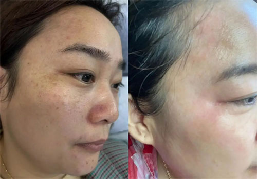 祛斑前后效果對比 祛斑最好的土方法有哪些?