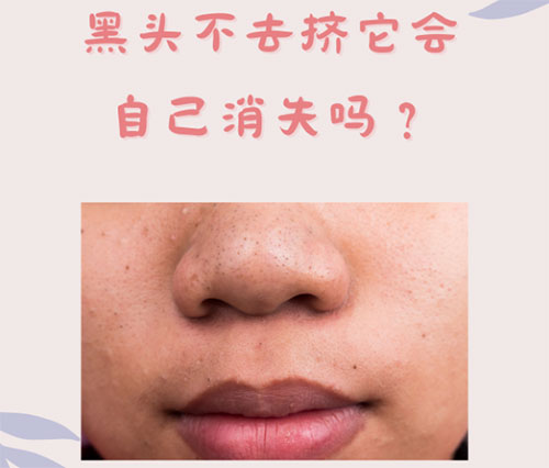 黑頭 什么是黑頭?怎樣預防黑頭的形成?