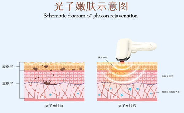 光子嫩膚術(shù)前注意事項有哪些?