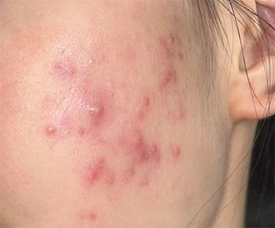 油痘肌和油敏肌怎么區(qū)分？油痘肌和油敏肌的區(qū)別！