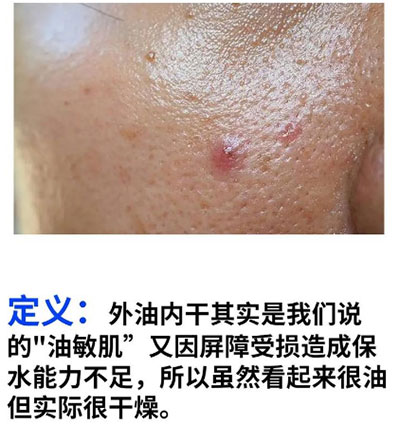 油痘肌和油敏肌怎么區(qū)分？油痘肌和油敏肌的區(qū)別！