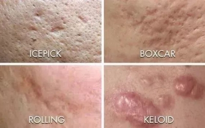 如何祛除痘坑？祛除痘坑最好的方法