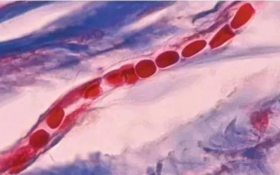 紅血絲是什么原因?qū)е碌模考t血絲形成的原因！