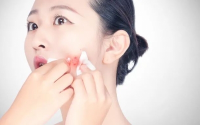 如何預防粉刺的發(fā)生和痤瘡的形成？