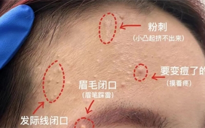 臉上經(jīng)常長閉口粉刺的原因有哪些？