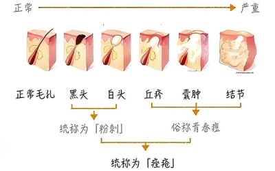 黑頭怎么去除最有效？去除黑頭最有效的方法