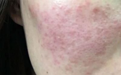 皮膚泛紅癢是什么原因？皮膚紅癢怎么回事？