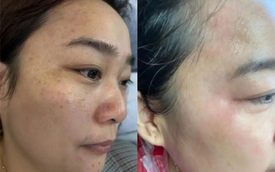 祛斑最好的土方法有哪些？