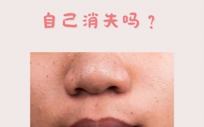 什么是黑頭？怎樣預防黑頭的形成？