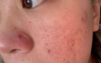 去痘印做什么醫美項目最好？