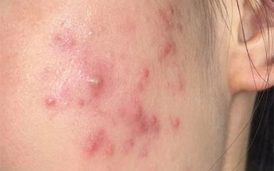 油痘肌和油敏肌怎么區分？油痘肌和油敏肌的區別！